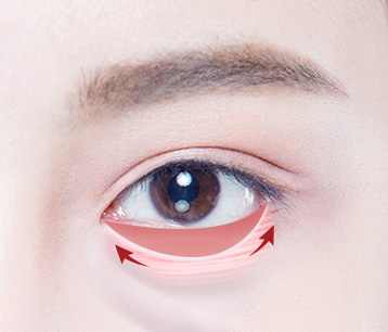 eyelidUnderstep이미지