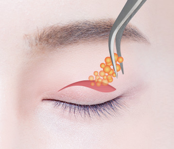 eyelidUpstep이미지