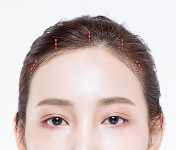 foreheadstep이미지