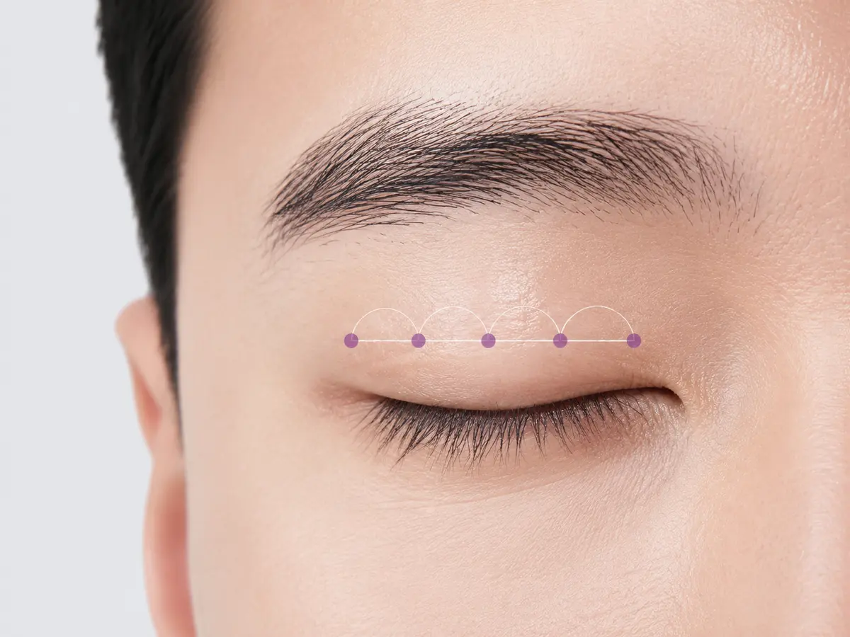 남성 눈꺼풀의 낮은 라인에 다섯 고정 포인트를 연결한 수술 원리 연출 이미지